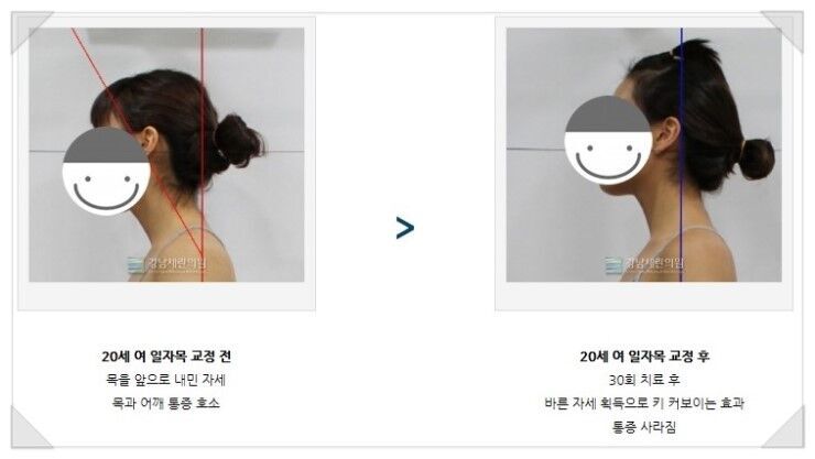 거북목교정운동 따라하기