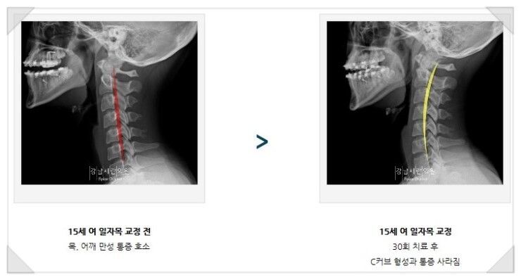 거북목교정운동 따라하기
