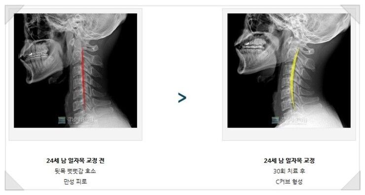 거북목교정운동 따라하기
