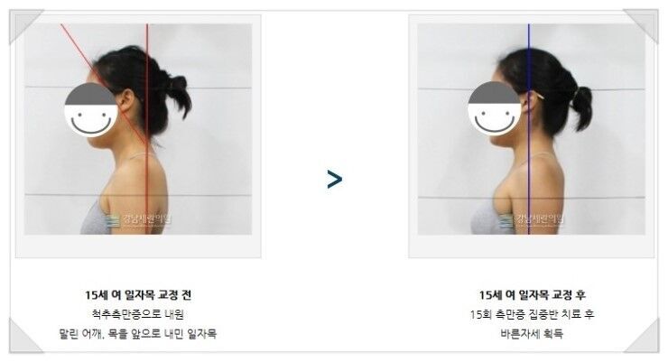 거북목교정운동 따라하기